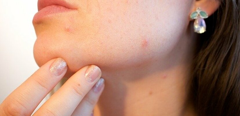 Evo zašto vam koža izgleda tako loše tokom izolacije?