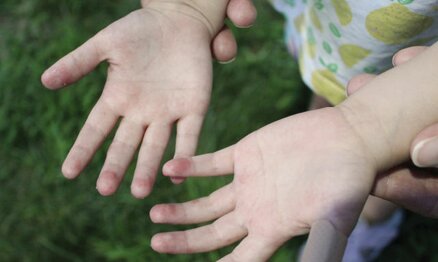 Atopijski dermatitis: Više od kožne bolesti, alarmantni podaci o kvalitetu života pacijenata