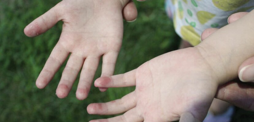 Atopijski dermatitis: Više od kožne bolesti, alarmantni podaci o kvalitetu života pacijenata