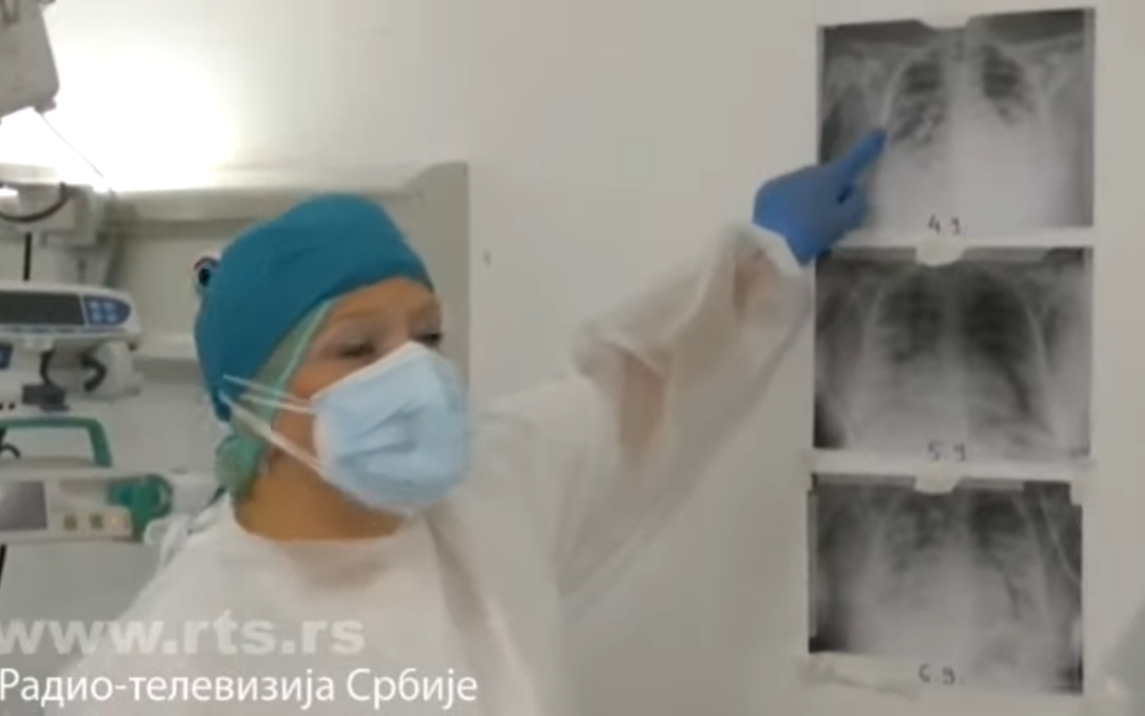 Pogledajte potresni snimak, korona UNIŠTILA pluća zdravoj devojci od samo 20 godina (VIDEO)