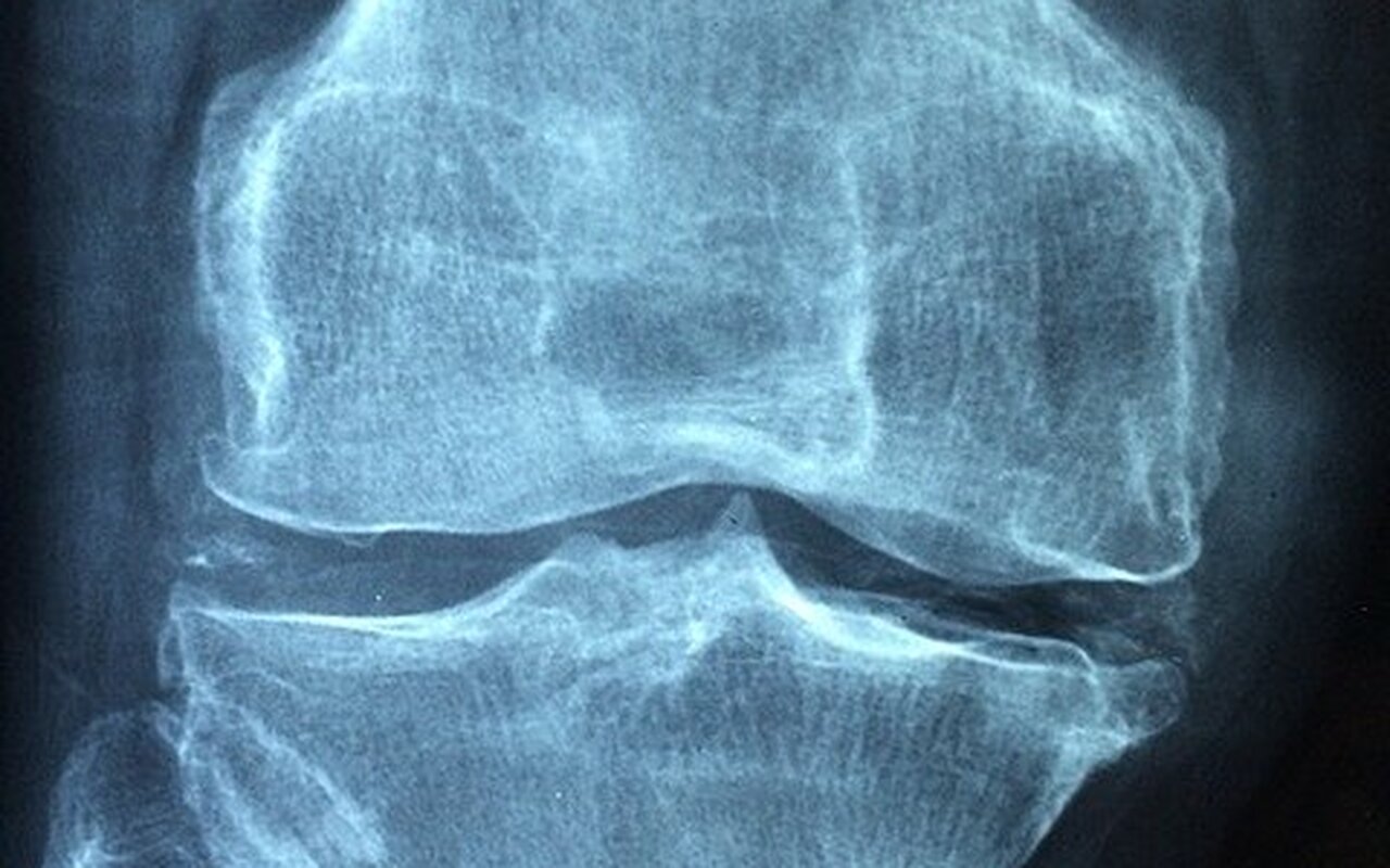 Sve što treba da znate o osteoporozi: kako se leči, šta je uzrok i kako je lekar dijagnostikuje