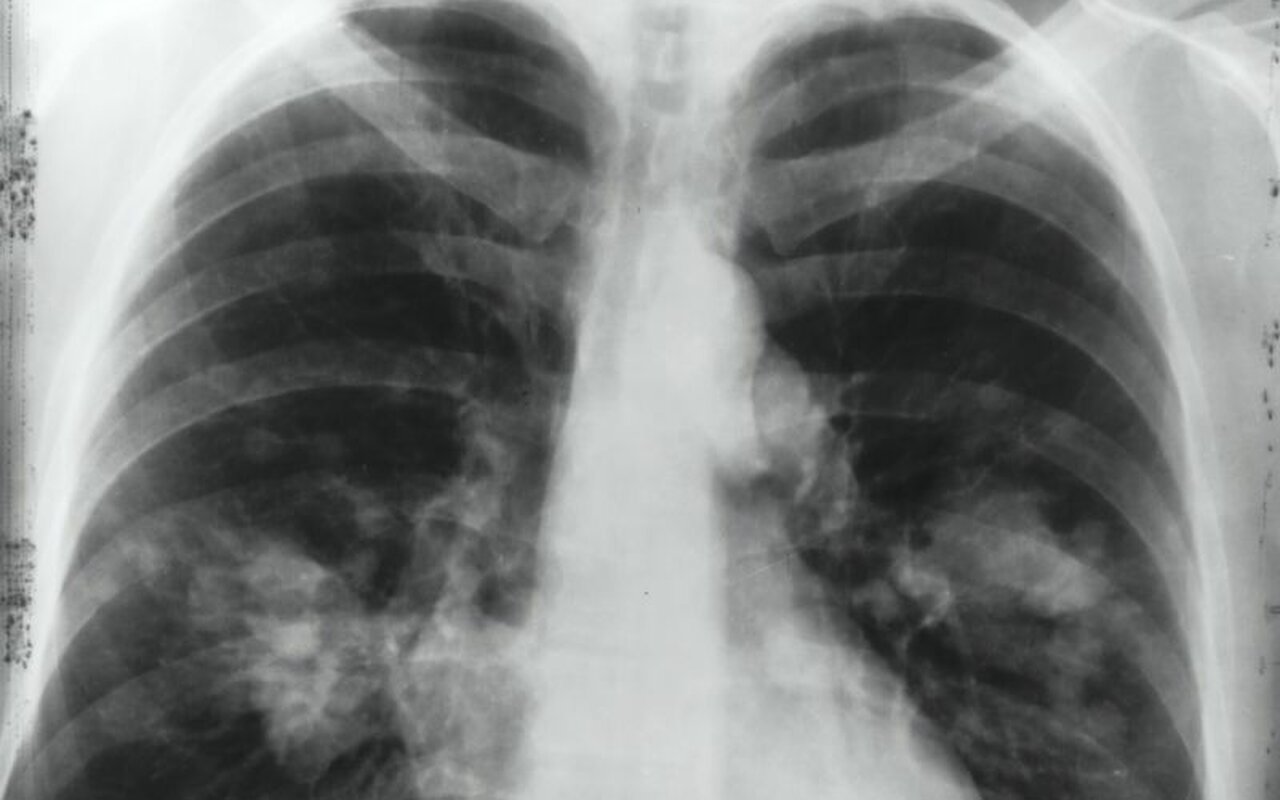 Rak pluća - nema faza je najopasnija, šta pušači treba da rade posle 40?