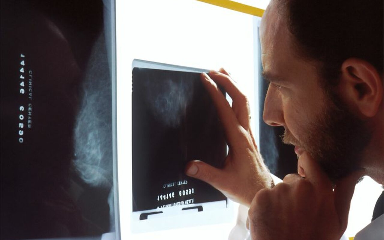 Rak prostate u Srbiji pogađa više od 2.000 muškaraca godišnje