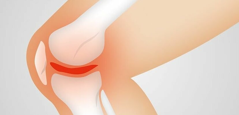 Problemi sa meniskusima – simptomi, uzroci i mogućnosti lečenja