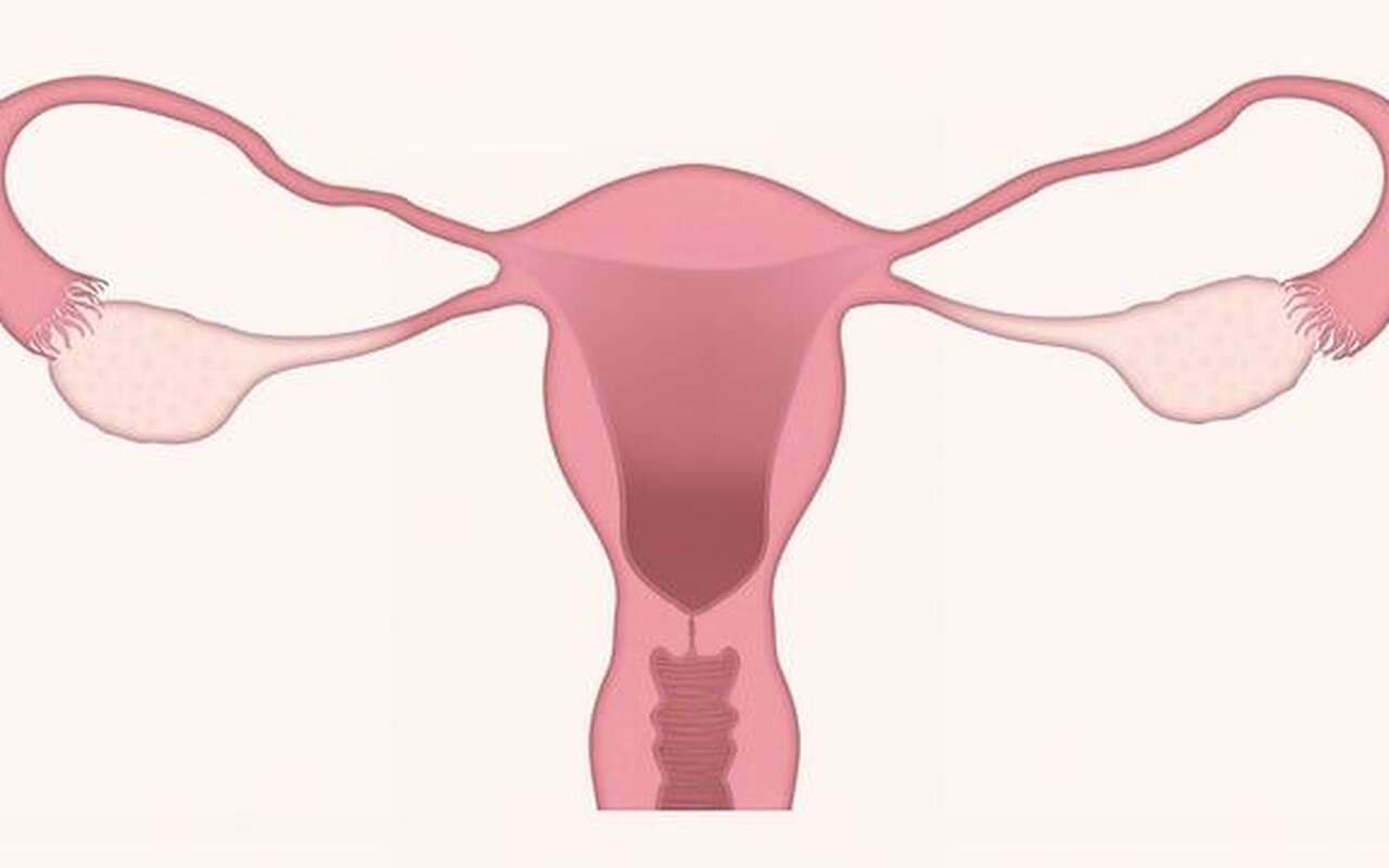 Šta su endometrijalni polipi?
