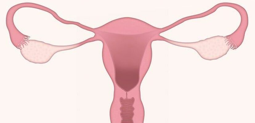 Šta su endometrijalni polipi?